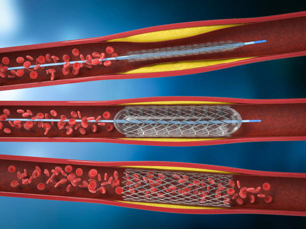 Stent Tedavisi